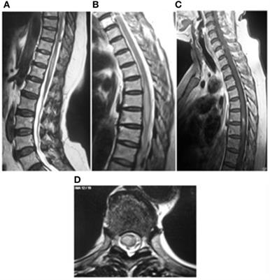 Clinical and Magnetic Resonance Imaging Findings of Neurotoxocariasis
